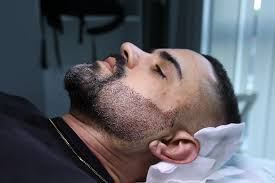 Beard transplant Nagpur