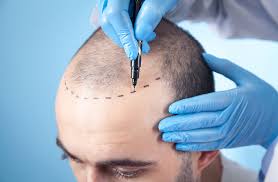 Best hair transplant clinic Nagpur