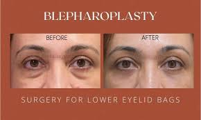 Blepharoplasty in Nagpur