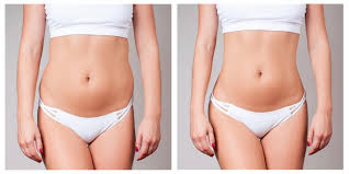 Body shaping surgery Nagpur