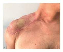 Burn Reconstruction Surgery Nagpur