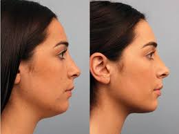 Chin surgery Nagpur