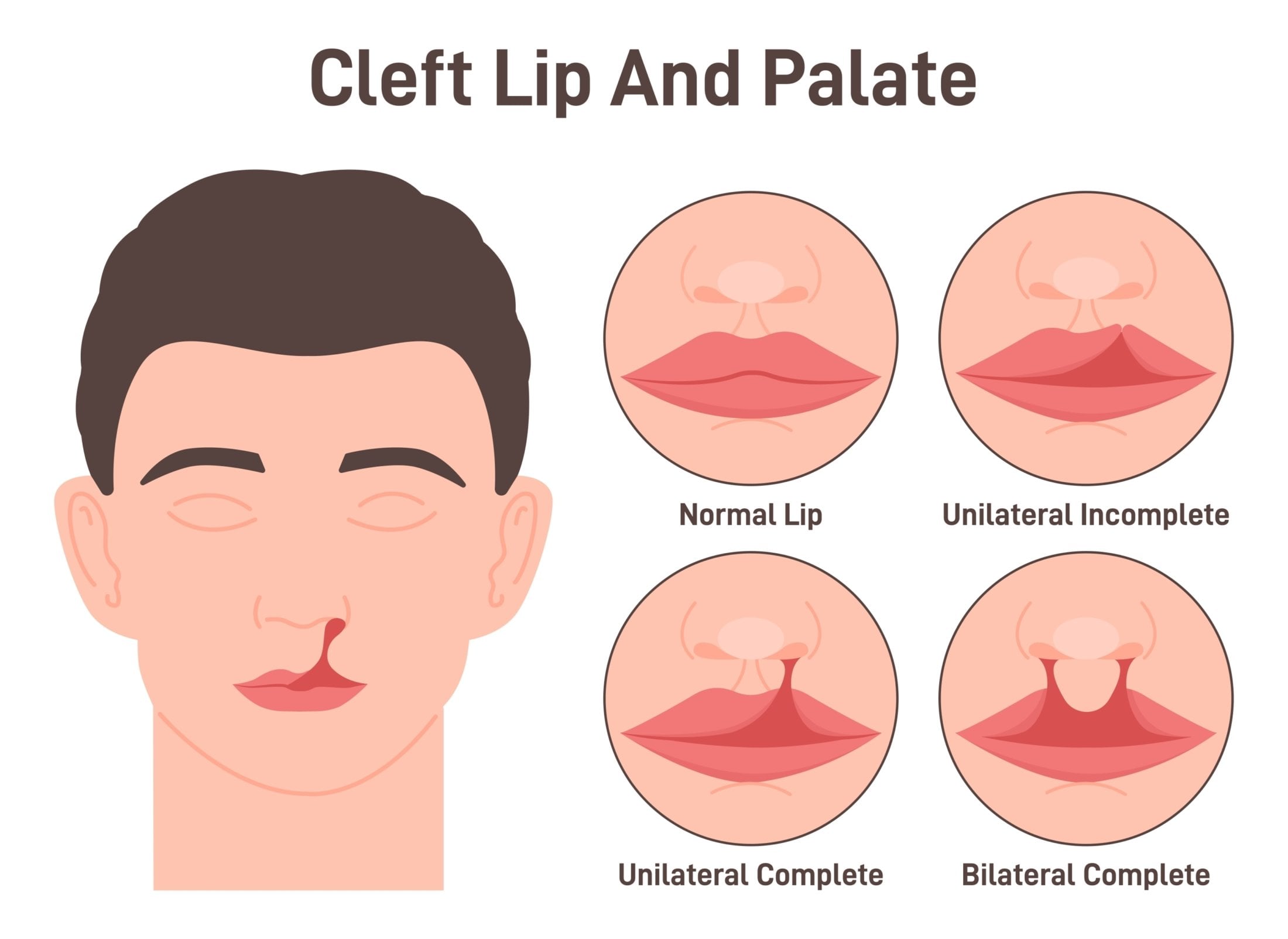 Cleft Lip Surgery Nagpur
