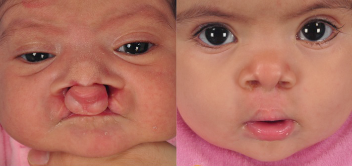 Cleft Palate Surgery Nagpur