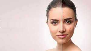 Cosmetic Scar Revision Nagpur