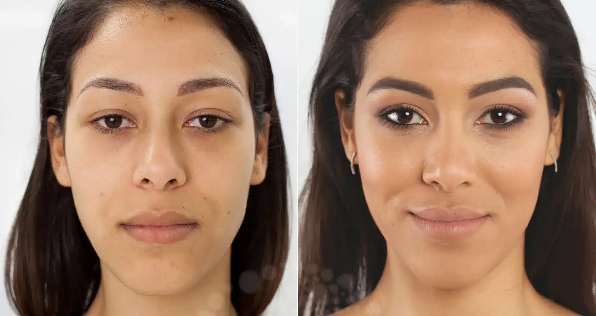 Eyelid surgery Nagpur