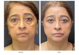 Fat grafting Nagpur