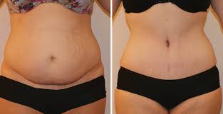 Fat removal surgery Nagpur