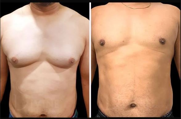 Gynecomastia Cost Nagpur