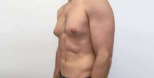 Gynecomastia surgery Nagpur