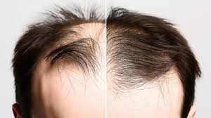 Hair Restoration Clinic Nagpur