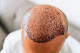 Hair transplant in Nagpur