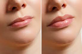 Lip surgery in Nagpur