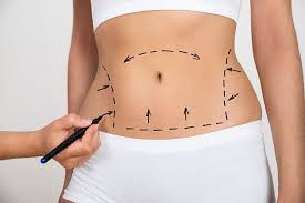 Liposuction in Nagpur