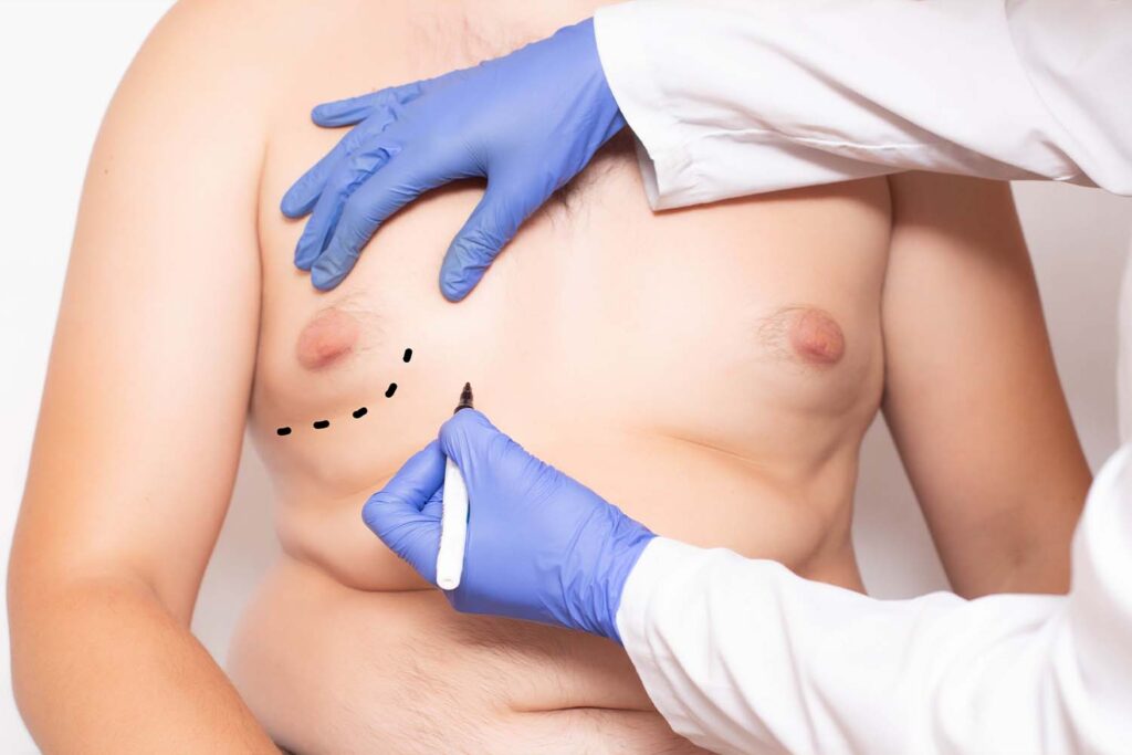 Male Breast Reduction Nagpur