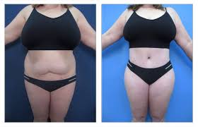 Mommy makeover Nagpur