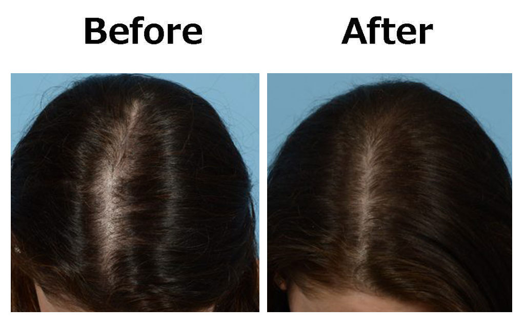 PRP hair treatment Nagpur
