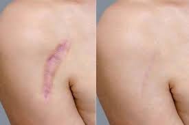 Scar removal surgery Nagpur