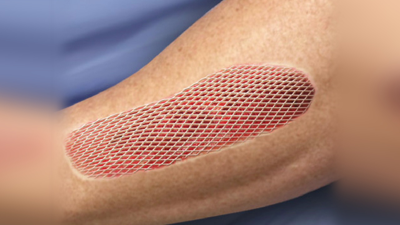 Skin Grafting Nagpur