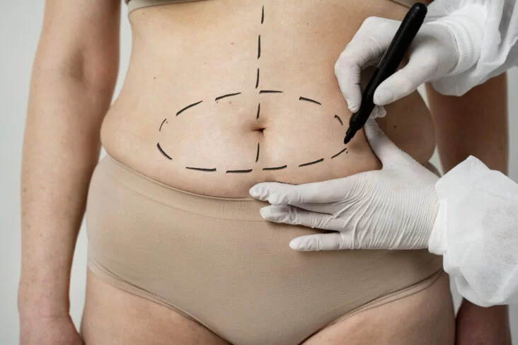 Affordable Liposuction Clinic In Nagpur
