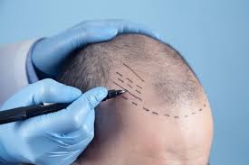 Hair Transplant Specialist In Nagpur